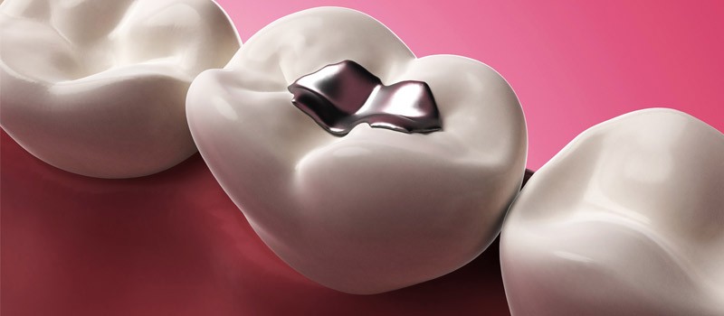 مراقبت‌های بعد از پر کردن دندان