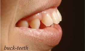 اصلاح دندان های خرگوشی