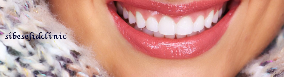 replacing-composite-veneer-with-tooth-lamination