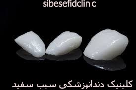 تفاوت لمینت دندان و لومینیرز