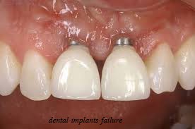 ایمپلنت دندان ناموفق و شکست درمان