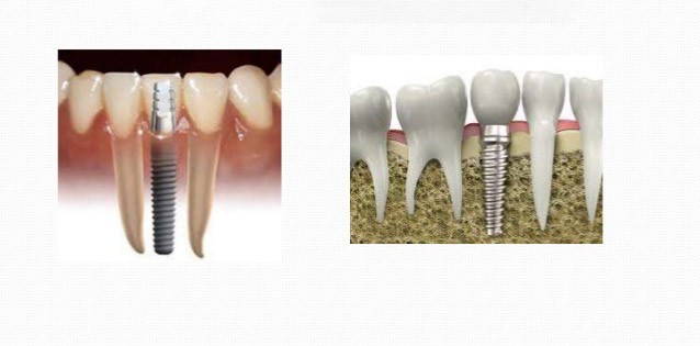 implant-osteoporosis