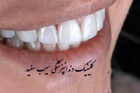 همه چیز درباره ی لمینت دندان لومینیرز