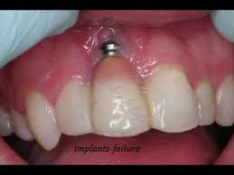 dental-implants-failure