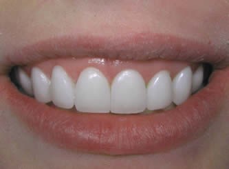 چگونه ونیر های دندان در طول زمان تغییر یافته اند؟