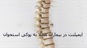 ایمپلنت دندان برای کسانی که پوکی استخوان دارند