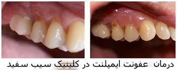 treatment-of-peri-implantitis