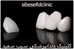 compression-of-lumineers-and-ceramic-lamination