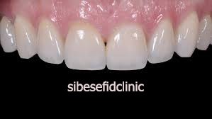 تعویض کامپوزیت با لمینت دندان و لومینیرز