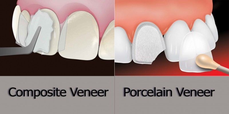 تفاوت ونیر کامپوزیت و لمینت سرامیکی