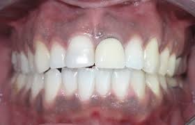 علت سیاه شدن لثه