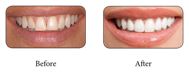 باندینگ دندان چیست؟