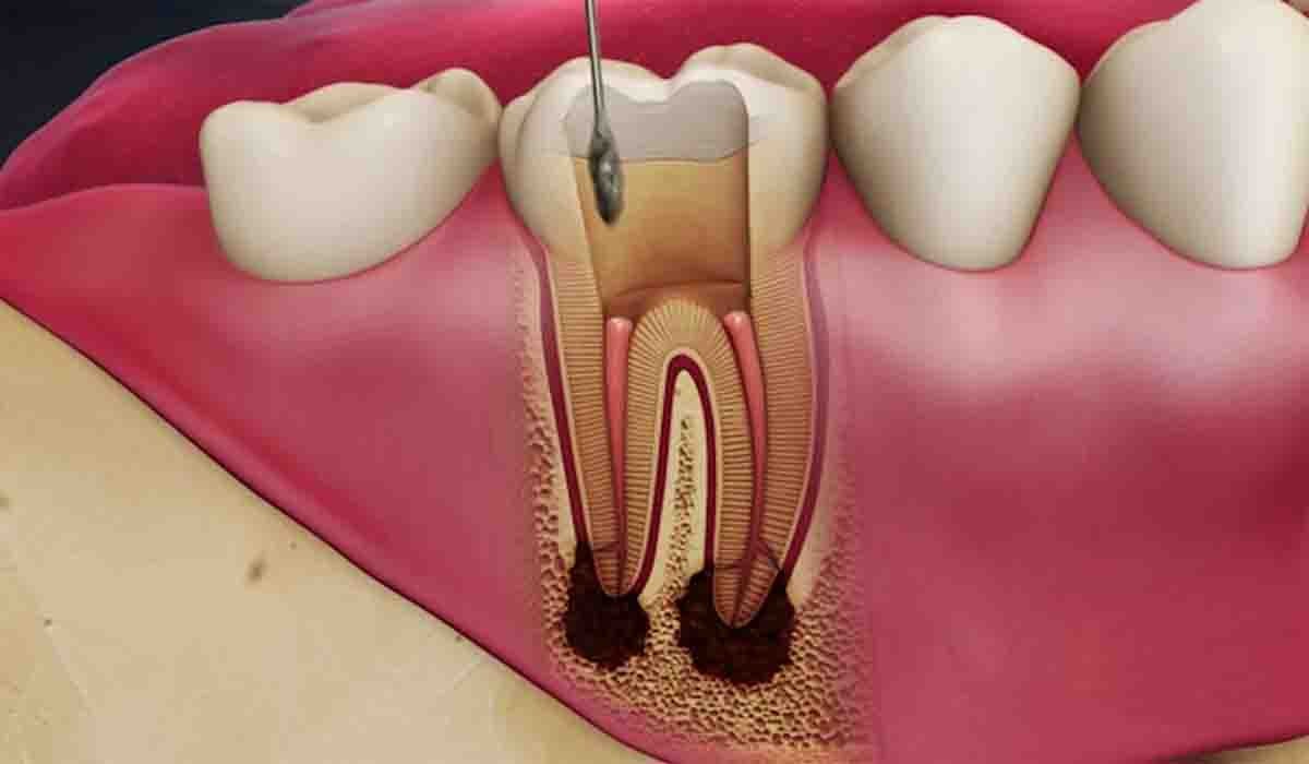 عصب کشی دندان - درمان ریشه (ENDO)