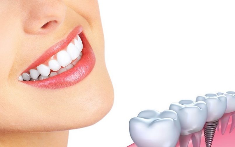 ایمپلنت برای بیماران دیابتی