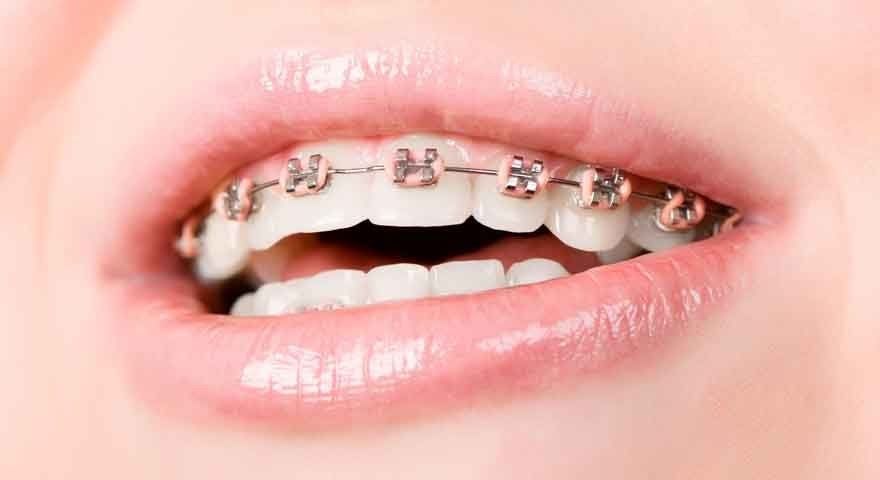 ارتودنسی دیمون چیست؟