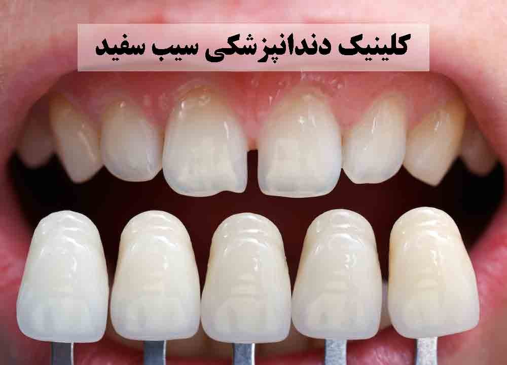 بوی بد دهان بعد از انجام کامپوزیت دندان