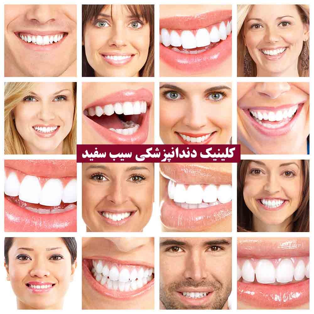 لمینت دندان که این روزها همه از آن صحبت میکنند چیست؟