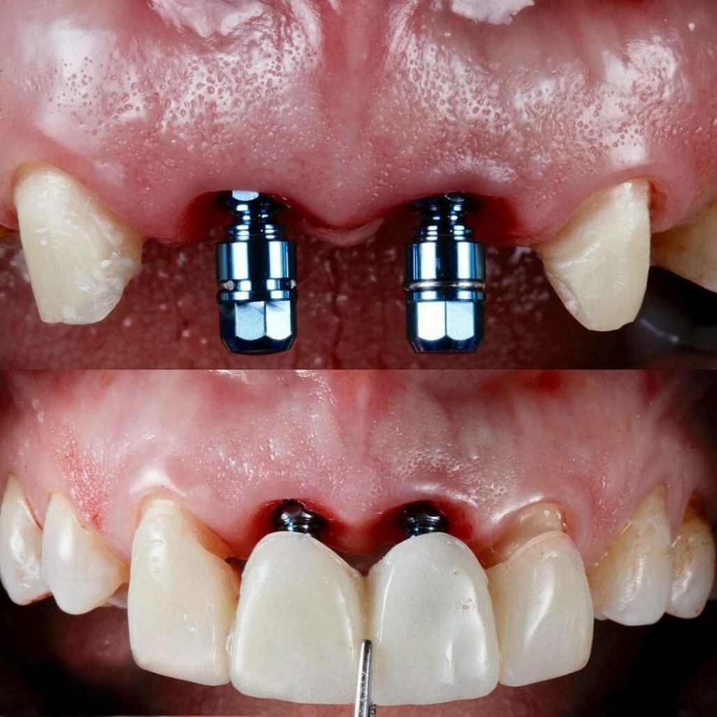 مراقبت های بعد از عمل جراحی ایمپلنت