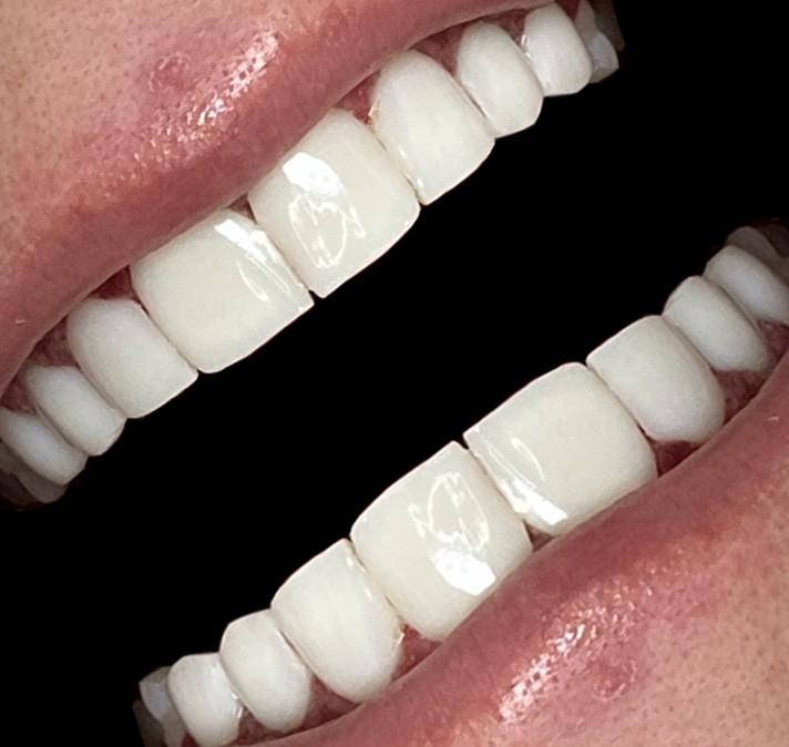 ضخامت کامپوزیت دندان