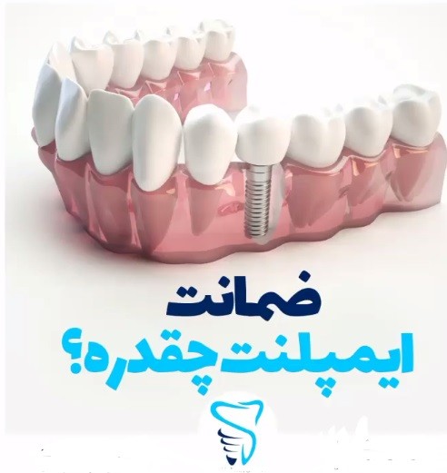 ضمانت ایمپلنت چقدر است؟