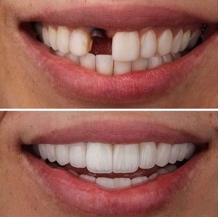 میزان موفقیت در ایمپلنت دندان