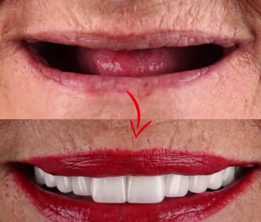 آیا میتوان چند سال بعد از کشیدن دندان ایمپلنت انجام داد؟