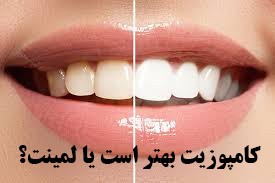 لمینت زیباتر است یا کامپوزیت ونیر؟