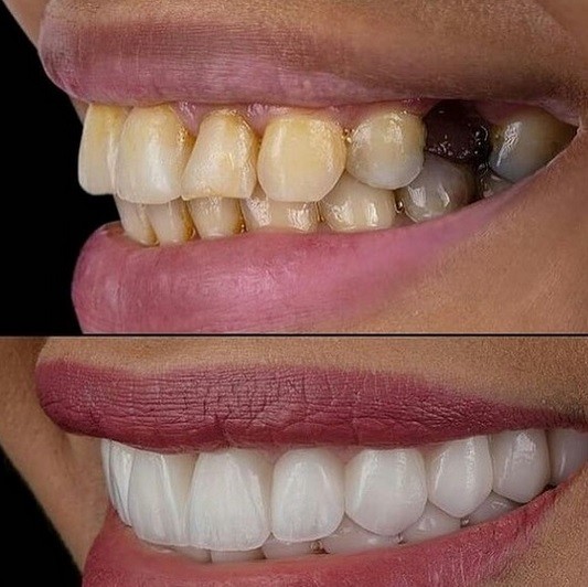 چرا باید ایمپلنت دندان را انجام داد؟