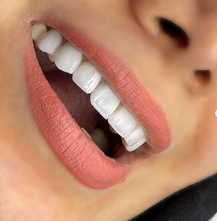چند نوع درمان زیبایی برای اصلاح رنگ و فرم دندانها داریم؟