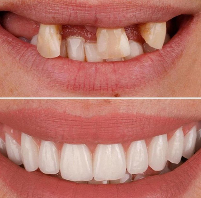 در چه مواردی از ایمپلنت کاشت دندان استفاده می شود؟