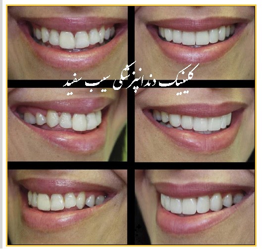 راز طبیعی بنظر رسیدن کامپوزیت ونیر چیست؟