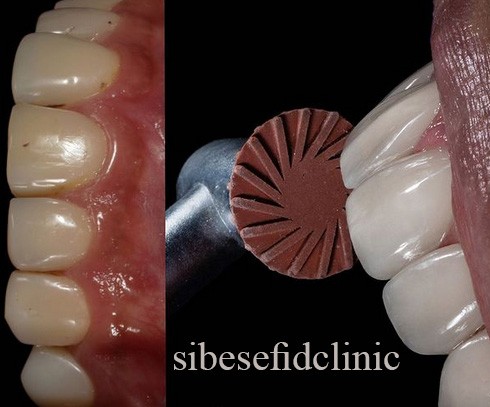 کامپوزیت طبیعی و براق