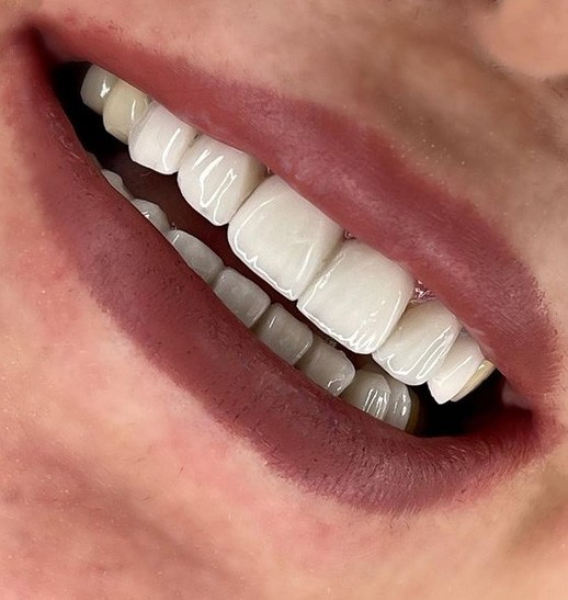 انتخاب رنگ لمینت دندان