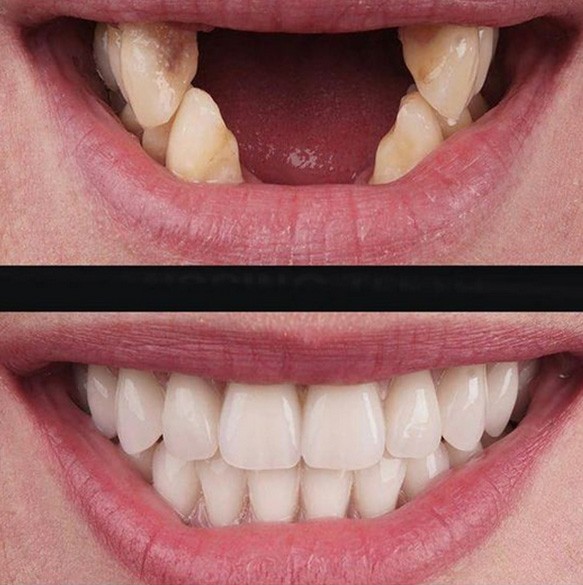 مراقبت های بعد از انجام ایمپلنت دندان