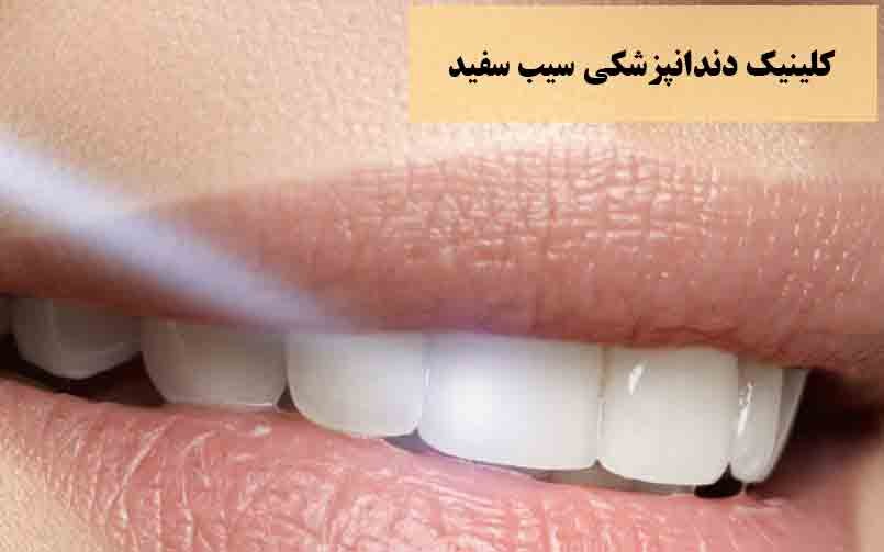 همه نکته هایی که لازم است قبل از کامپوزیت دندان بدانید