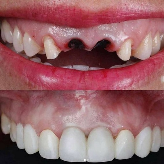 تصورات غلطی که درباره‌ ایمپلنت‌ وجود دارد