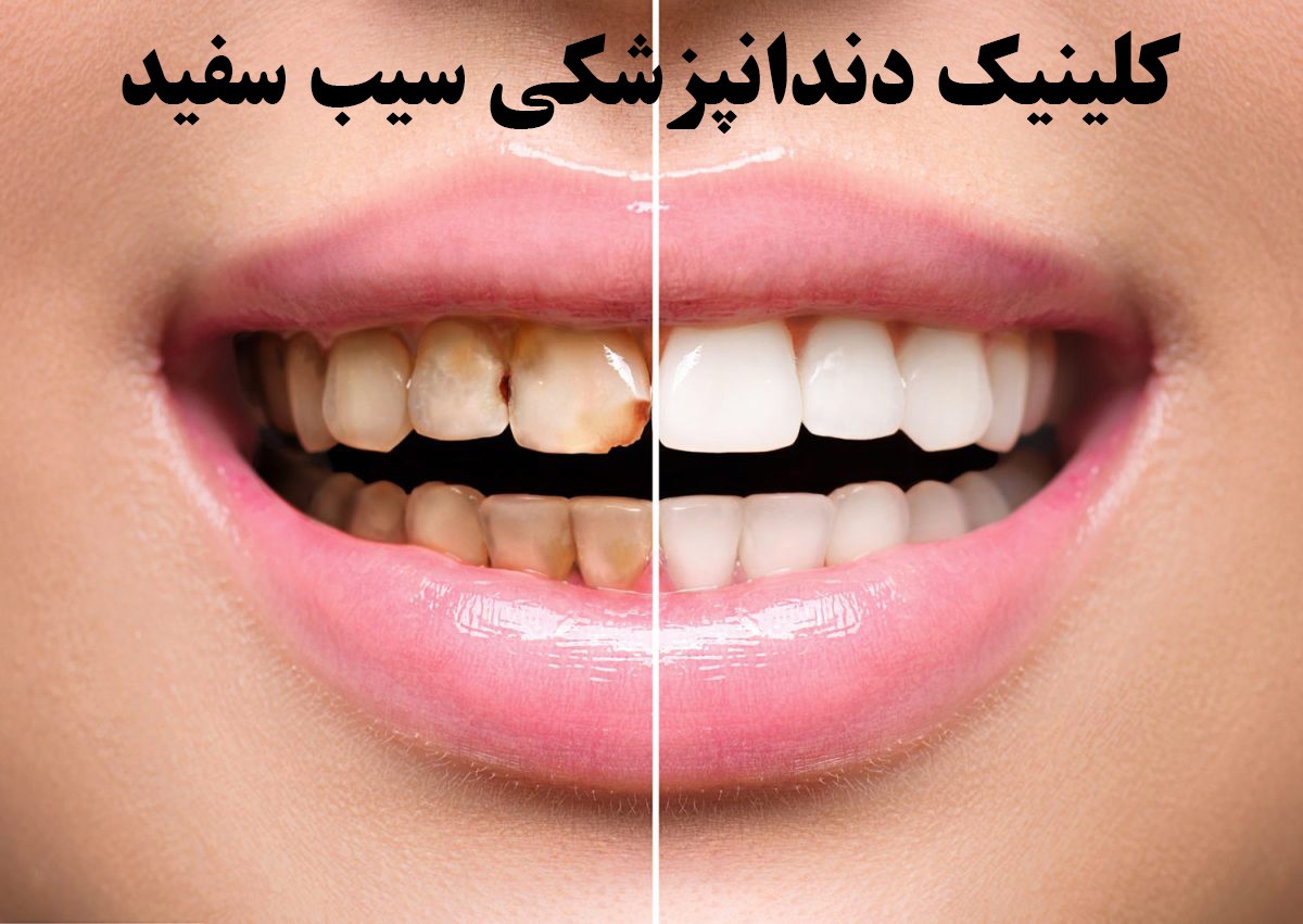 انواع مختلف لمینت دندان