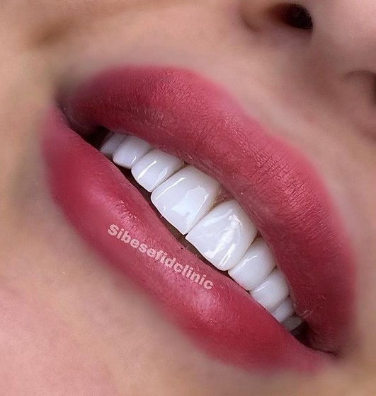 آيا درمان لمينت بهتر از کامپوزيت ونیر است؟