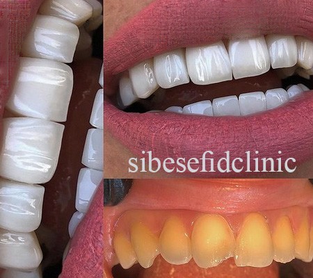 کامپوزیت دندان به روش لیرینگ