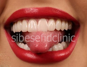 نکاتی که قبل از لمینت باید بدانید