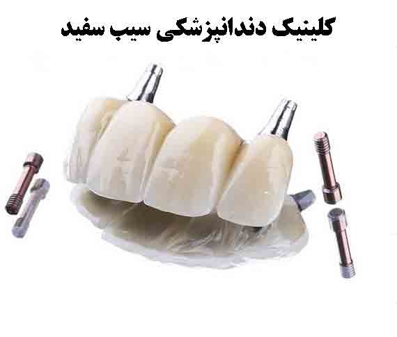 عوارض احتمالی کاشت ایمپلنت