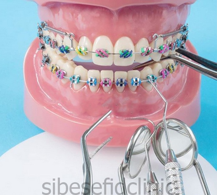 آیا ارتودنسی محدودیت سنی دارد؟