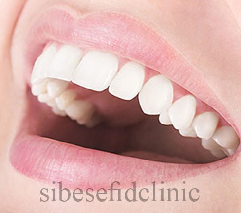 تراش دندان برای لمینت سرامیکی