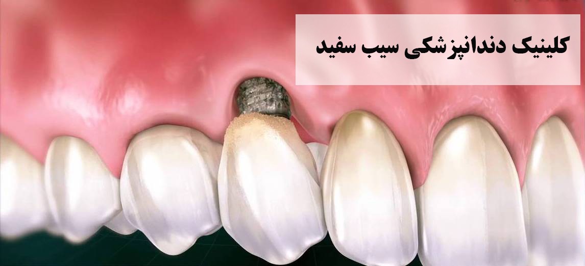 مشکلات ایمپلنت:لق شدن، عفونت