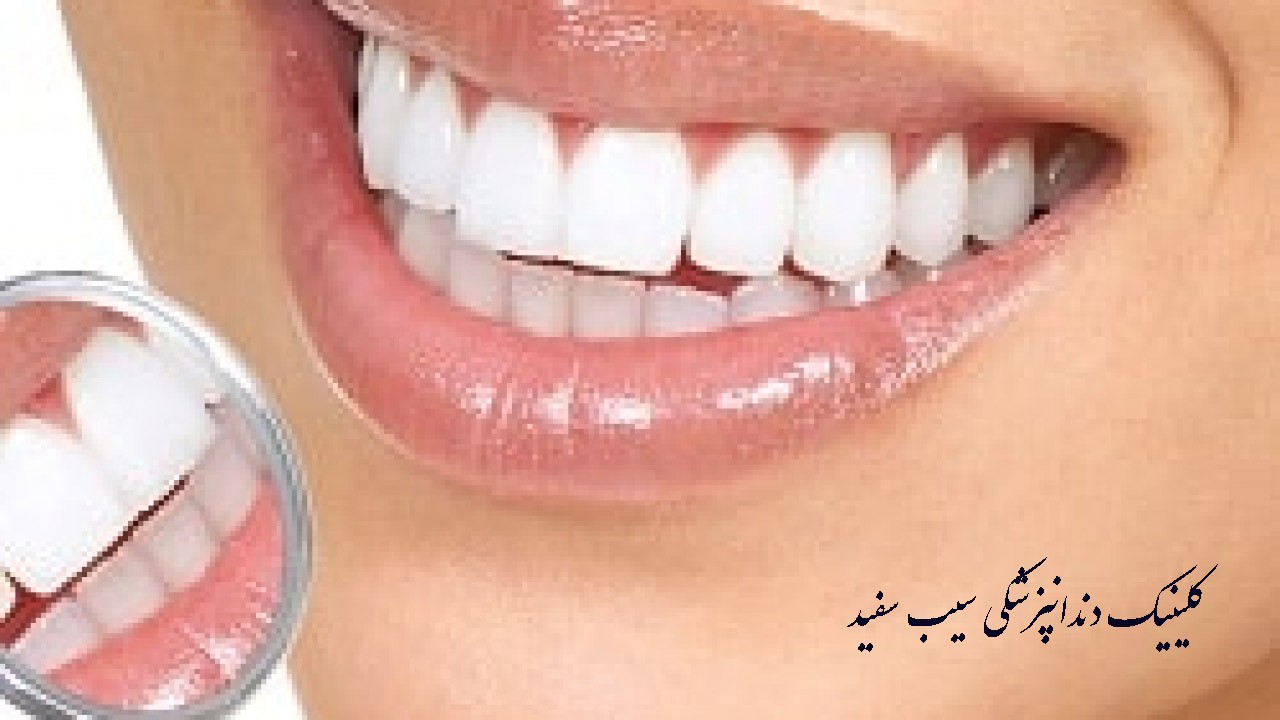 آیا دندان های فک پایین نیز باید کامپوزیت شوند