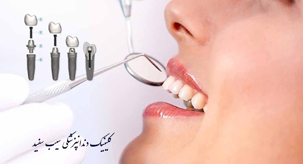 بهترین متخصص ایمپلنت دندان