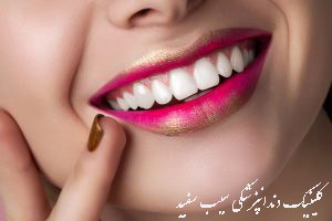 composite-veneer-complications