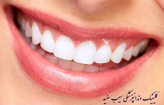 عوارض کامپوزیت دندان