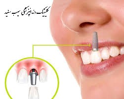 مراحل-انجام-ایمپلنت-دندان