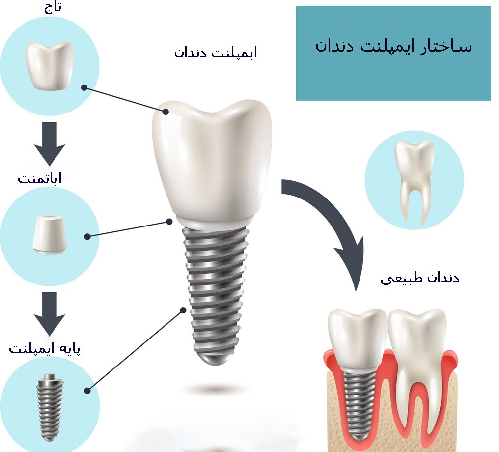 ساختار ایمپلنت دندان